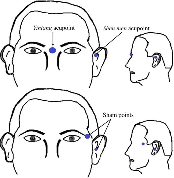 Exploring The Role Of Acupuncture And Acupressure In Managing Sleep Paralysis